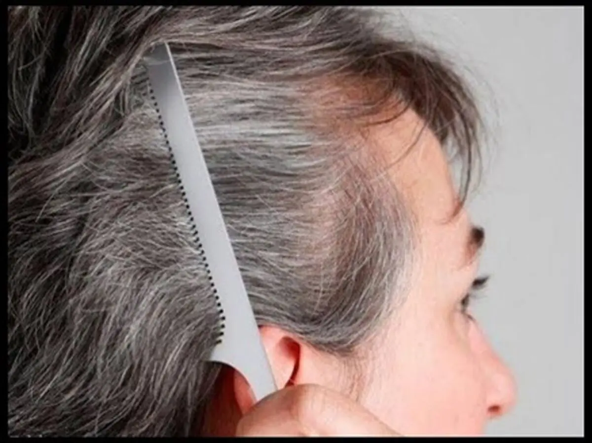 آیا موی کاشته شده سفید می‌شود؟