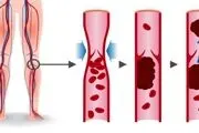 خطرات لخته خون در پا، علائم و راه‌های پیشگیری
