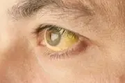   این علائم حکایت از نارسایی‌های کبد دارند