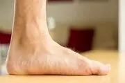 این باورهای قدیمی را درباره کف پای صاف باور نکنید