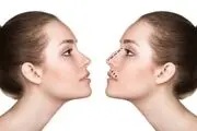 چه کسانی باید بینی خود را عمل کنند؟