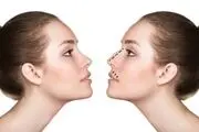 عوارض جراحی‌های ناشیانه زیبایی بینی