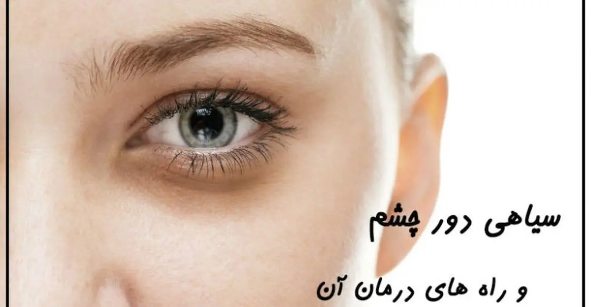 چگونه سیاهی و گودی زیر چشم را از بین ببریم؟