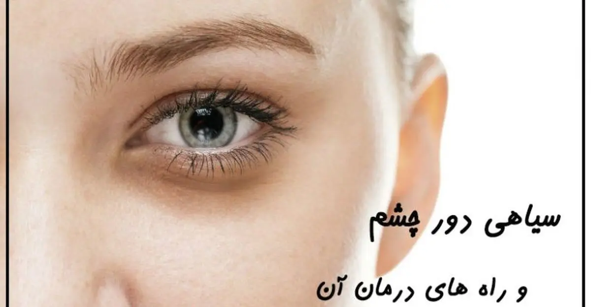 نسخه خانگی فوق‌العاده برای رفع سیاهی دور چشم