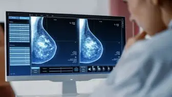 یافته جدید محققان در خصوص پیش بینی بازگشت دوباره سرطان سینه
