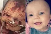 بلایی که مننژیت سر این کودک نوپا آورد