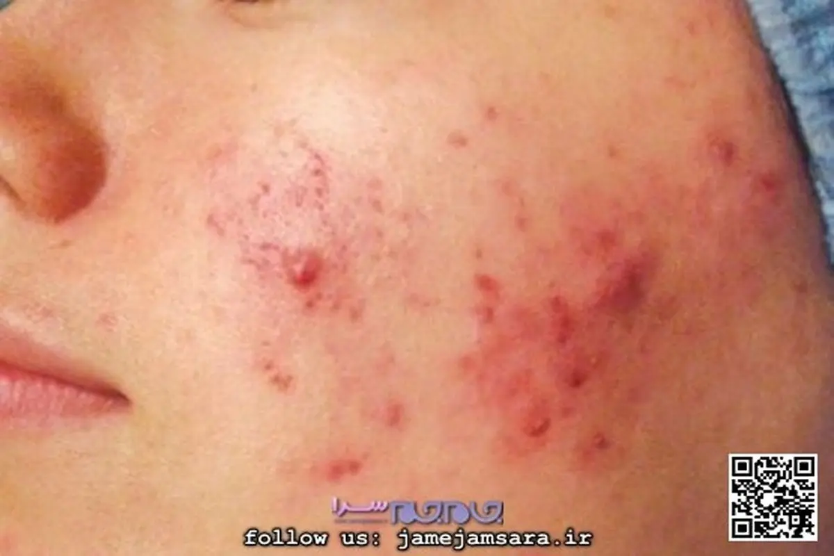 کدام آکنه سراغ تان آمده و چگونه درمان می شود؟+تصاویر