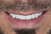 10 عدد از بهترین برند کامپوزیت دندان چیست ؟