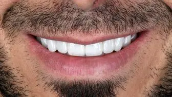 10 عدد از بهترین برند کامپوزیت دندان چیست ؟