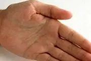 چرا انگشتان دستتان پف می‌کند؟