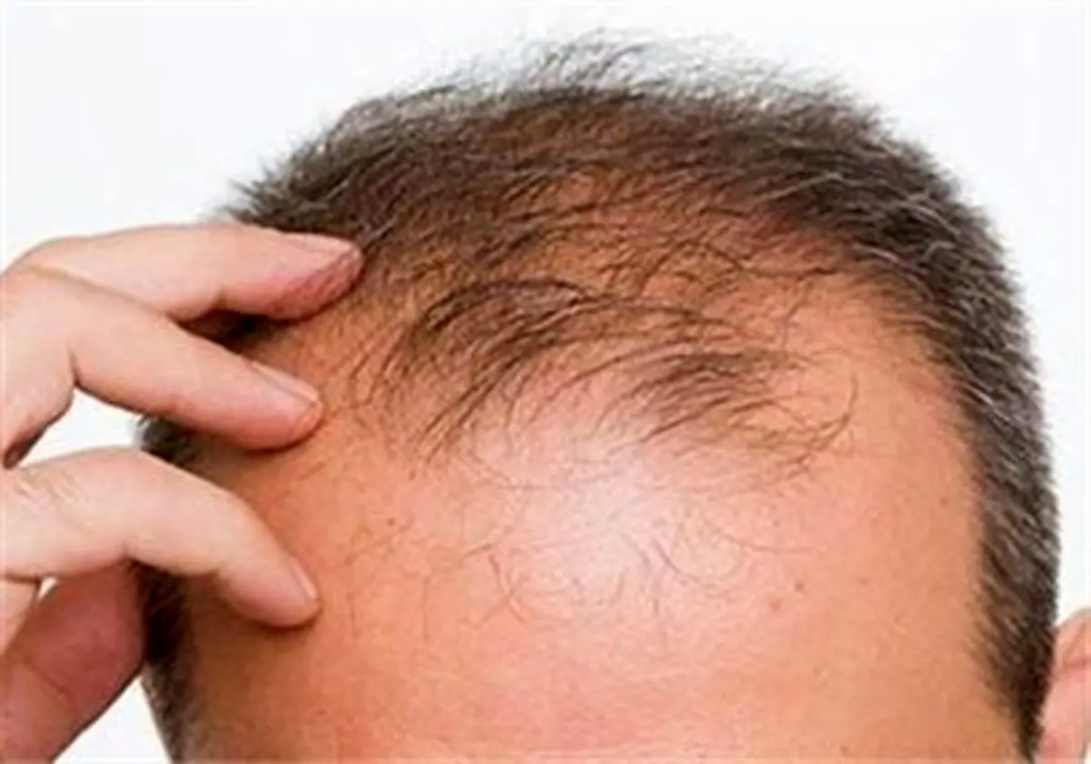 مکانیزم ریزش موی سکهای و تاسی سر از منظر طب سنتی