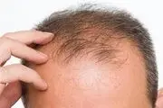 مکانیزم ریزش موی سکه‌ای و تاسی سر از منظر طب سنتی