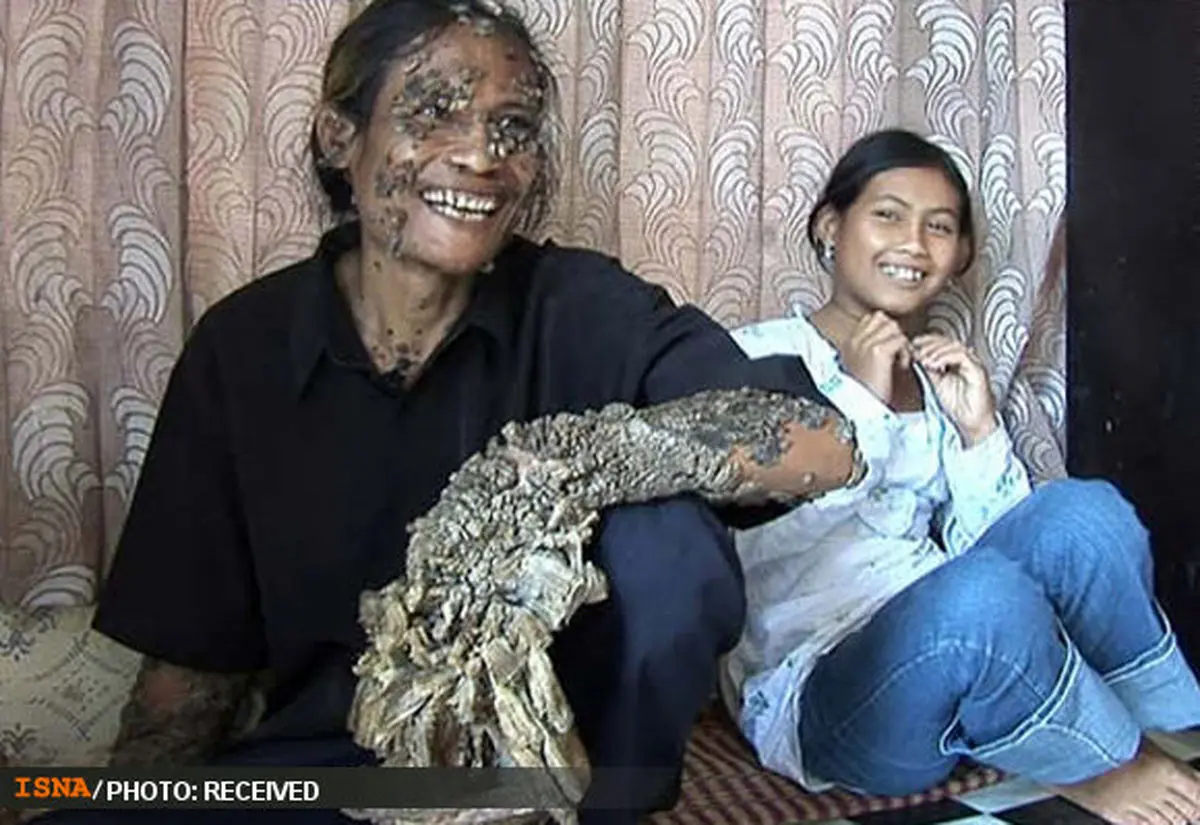 مردی در محاصره زگیل درختی + عکس