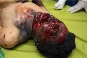 سوختگی جان 18 نفر را در پایخت گرفت