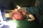 خارج کردن توده 5 کیلویی از شکم یک بیجاری

