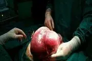 خارج کردن توده 5 کیلویی از شکم دختری در نقده