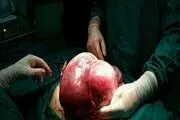 خارج کردن توده 5 کیلویی از شکم دختری در نقده