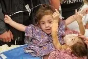 دوقلوهای دوساله آمریکایی جدا شدند +عکس