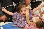 دوقلوهای دوساله آمریکایی جدا شدند +عکس