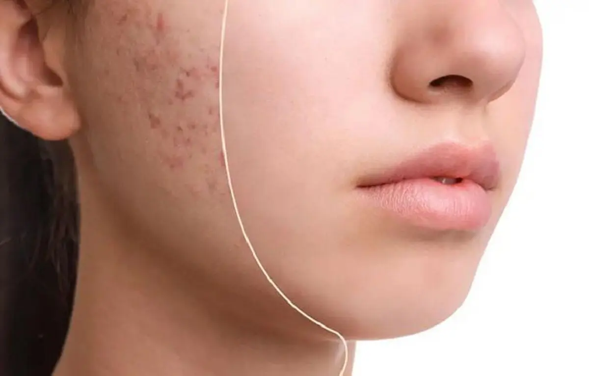 جوش‌ها به ما چه می‌گویند؟
