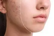 جوش‌ها به ما چه می‌گویند؟
