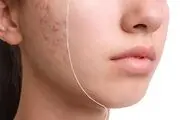 جوش‌ها به ما چه می‌گویند؟
