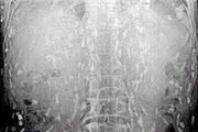 ده‌ها کِرم در شکم مردی که سوشی خورده بود