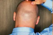 یبوست سبب ریزش مو می‌شود