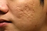 ۵ راهکار ساده که به سرعت از شر جوش و آکنه خلاصتان می‌کند