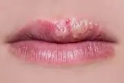 درمان تب خال به شیوه خانگی و ساده