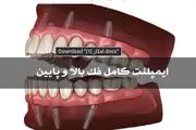 ایمپلنت کامل فک بالا و فک پایین