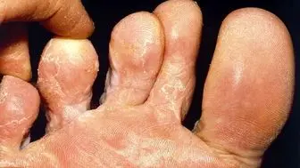 درمان کچلی پا با ضدعفونی کردن جوراب
