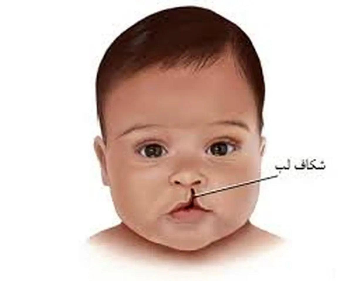چرا شکاف لب بوجود می آید؟