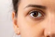 برای رفع گودی چشم چه کارهایی انجام دهیم


