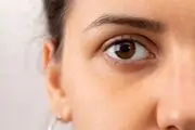 برای رفع گودی چشم چه کارهایی انجام دهیم



