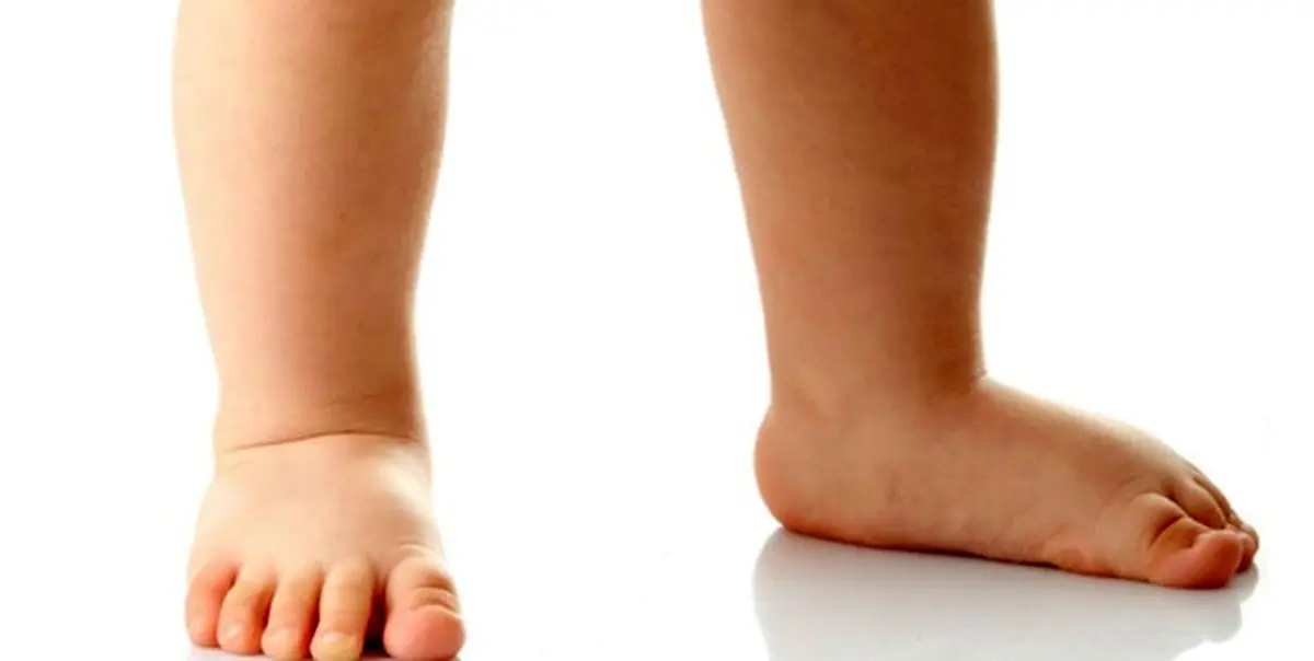 از هر ۱۰ کودک ایرانی ۸ کودک دچار کجی پا هستند
