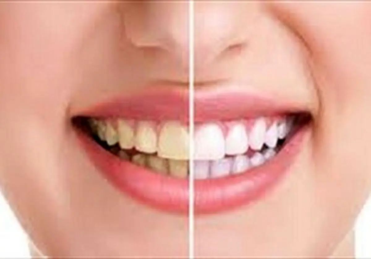 نشانه های مسواک زدن اشتباه