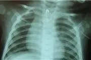 سنجاق قفلی در مری کودک 6 ماهه+تصاویر