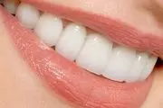 هشدار درباره استفاده از پودرهای سفید کننده دندان