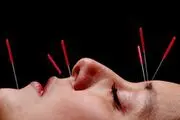 استفاده از طب سوزنی و مکمل در درمان کرونا صحت دارد؟