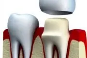 طول عمر روکش های دندانی چقدر است؟