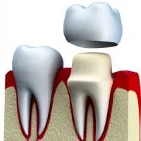 طول عمر روکش های دندانی چقدر است؟