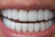 مشکلات لبخند هالیوودی برای لثه‌ها