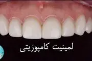 ​کامپوزیت دندان چیست؟

