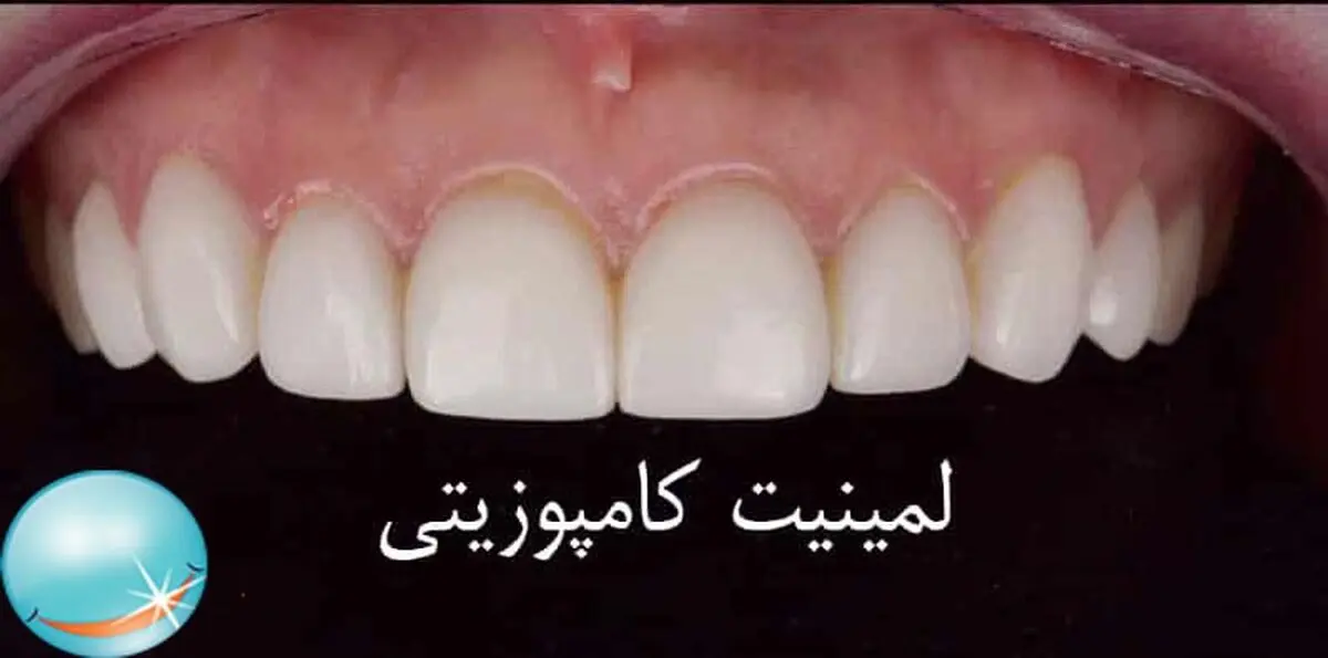 ​کامپوزیت دندان چیست؟

