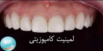​کامپوزیت دندان چیست؟


