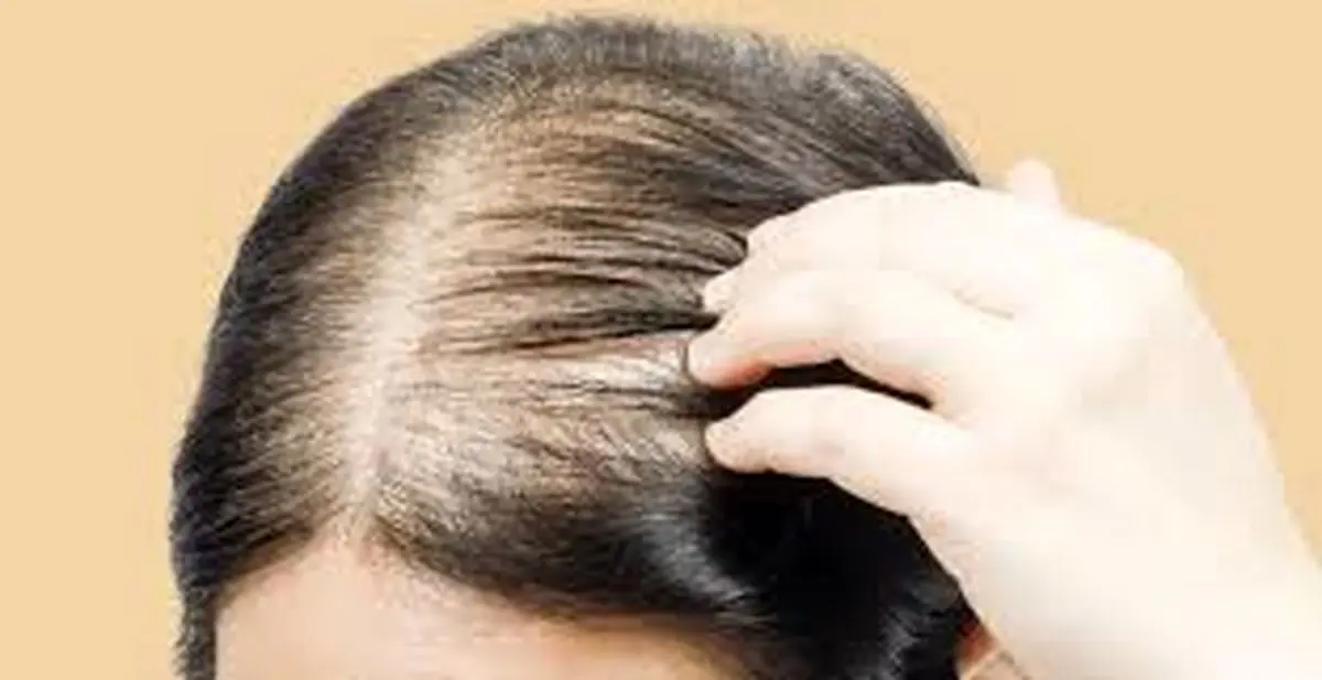 نازک شدن موها چه دلایلی می‌تواند داشته باشد؟ + اینفوگرافیک