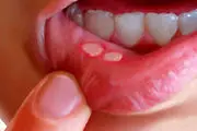 درمان طلایی آفت دهان