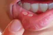 دارویی جدید برای رهایی از آفت دهان در ۲۰ ثانیه