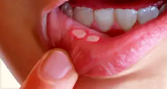 وقتی دهان کودکان زخم می شود